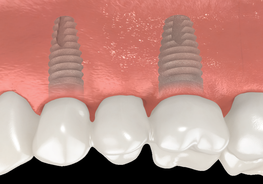 Final bridge is custom made to match your existing teeth