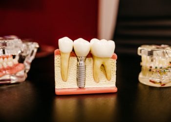 dental implant