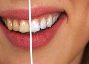 best dental whitening