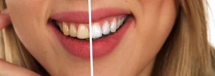 best dental whitening