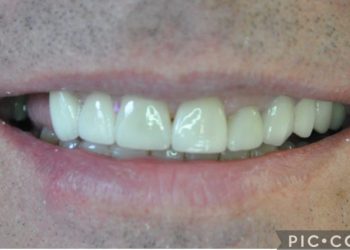 ceramic dental crown tilehurst