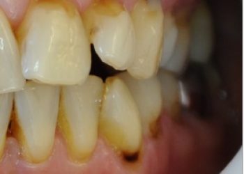 acid damage to teeth repaired at u'r smile