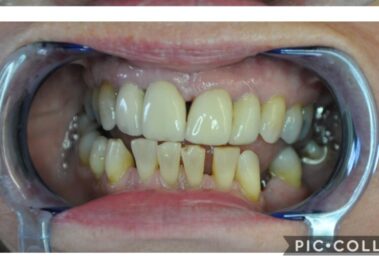 dental hygiene after dental treatment