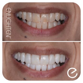 Enlighten teeth whitening Teeth whitening Reading