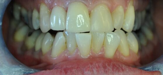 Ceramic crowns and bonding after bonded ceramic crown