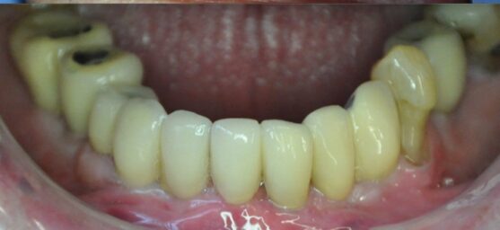 Dental implants after results of comprehensive dental treatment