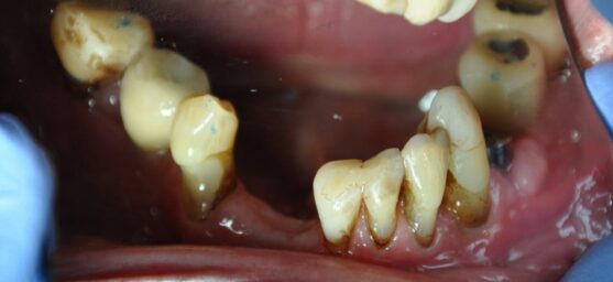 Missing teeth