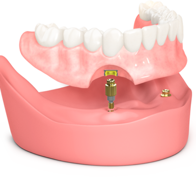 Implant supported Denture