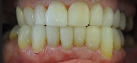 Smile-Direct-bonding-provisionals aftr Quick solution for uneven teeth