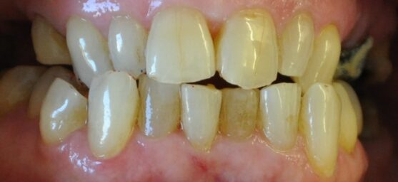 Smile Direct bonding of provisionals
