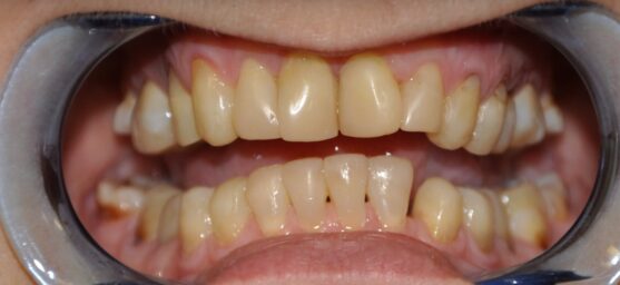 Smile makeover provisional stage after smile design