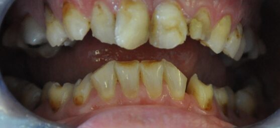 decompensated caries