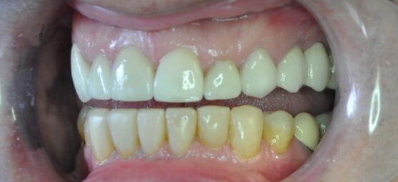 complex dental treatment after comprehensive dental treatment berkshire