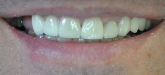 smile makeover after amazing results of dental treatment