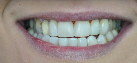 after Composite bonding, Reading, Berkshire