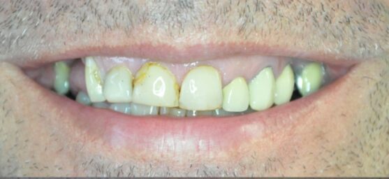 old dental crowns