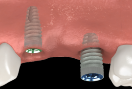 Implants are placed in the bone beneath the gum