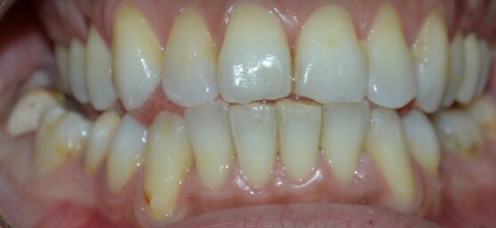 Results of orthodontic treatment Straight teeth reading
