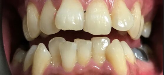uneven teeth