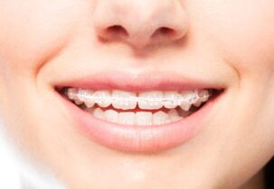 Dental braces3