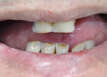 dental implants immediate