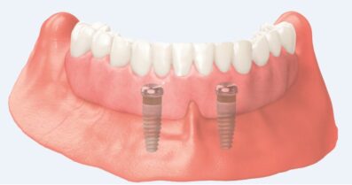 Denture supported by dental implants