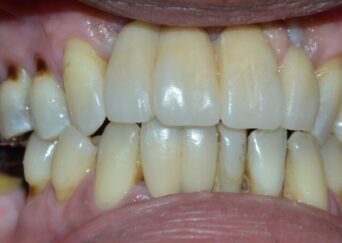 missing teeth impants bridge final 2