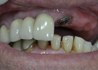 missing teeth implants