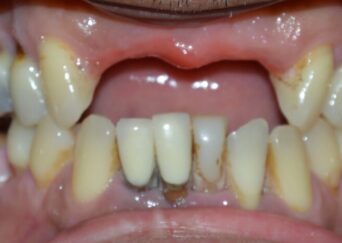 missing teeth implants bridge 2