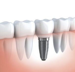 We provide dental implants for missing teeth. Dental implants are fixed, long-term solution for replacing missing teeth. Our clinic is fully equiped to provide Dental implants cleaning and scaling services to prolong the life of the Dental implants. 