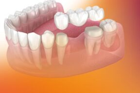 Dental crowns and bridges are great solutions when buildup of tooth or implant is not an option. Crowns and veneers can enhance appearance and funtion of the teeth to achieve the best results. 