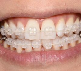 Not happy with your mal-aligned or gappy teeth? Book a virtual consultation by asking for it when you contact us. Deposit of £30 is required to book the appointment. We routinely provide invisible aligners and fixed braces treatments to help acheive U'r ideal smile.